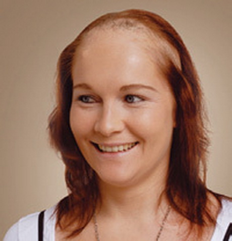 Der gebietsmäßige Haarausfall